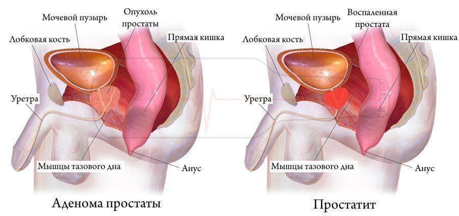 prostatitis rectum